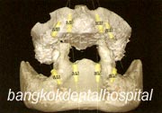 all-on-4 ~{B|9H~}, all-on-4 ~{L)9z~}, all-on-4 ~{V2Hk~}
