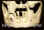 all-on-4~{HK9$V2Q@B|9H~}, all-on-4~{HK9$V2Q@L)9z~}