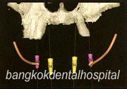 all-on-4~{HK9$V2Q@B|9H~}, all-on-4~{HK9$V2Q@L)9z~}